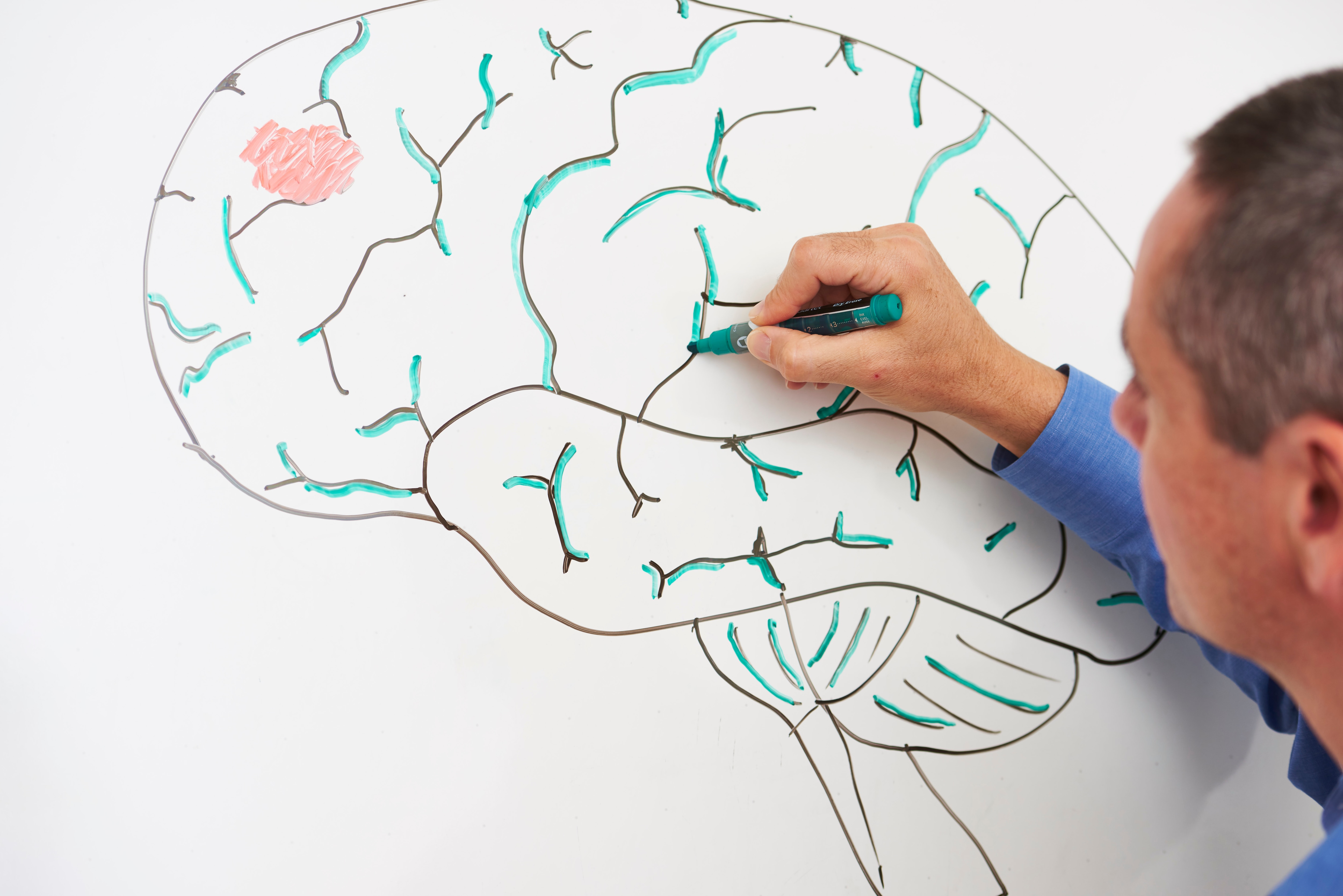 Brain tumor (red) shown within the frontal part of the brain